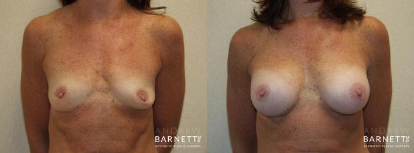 Breast Augmentation Walnut Creek