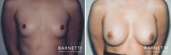 Breast Augmentation Walnut Creek