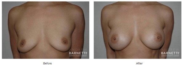 Breast Augmentation Walnut Creek