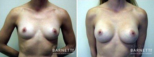 Breast Augmentation Walnut Creek