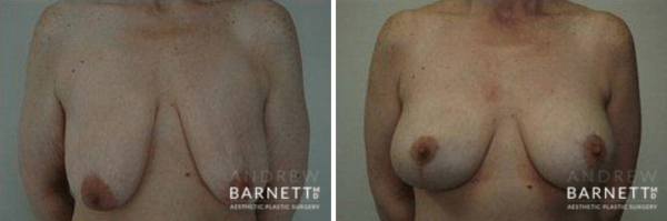 Breast Reduction Walnut Creek