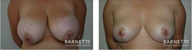 Breast Reduction Walnut Creek