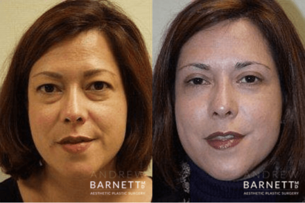 Eyelid Lift Walnut Creek