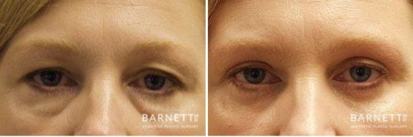 Eyelid Lift Walnut Creek