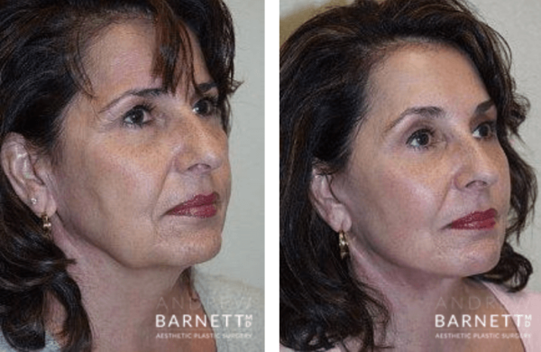 Facelift Walnut Creek