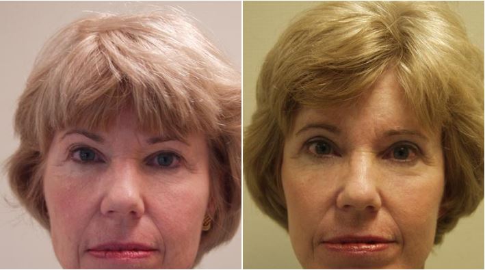 Facelift Walnut Creek