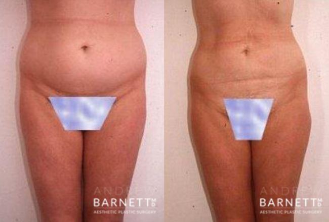 Liposuction Walnut Creek