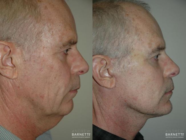 Neck Lift Walnut Creek