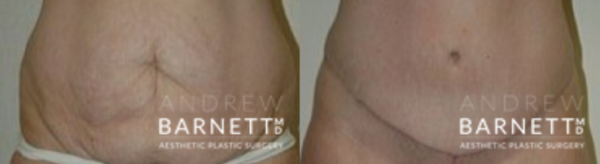 Tummy Tuck Walnut Creek