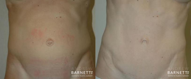 Tummy Tuck Walnut Creek