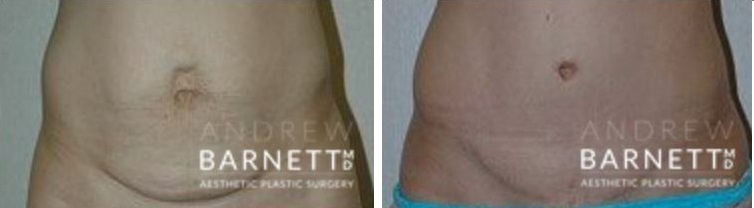 Tummy Tuck Walnut Creek