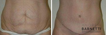 Umbilicus Walnut Creek