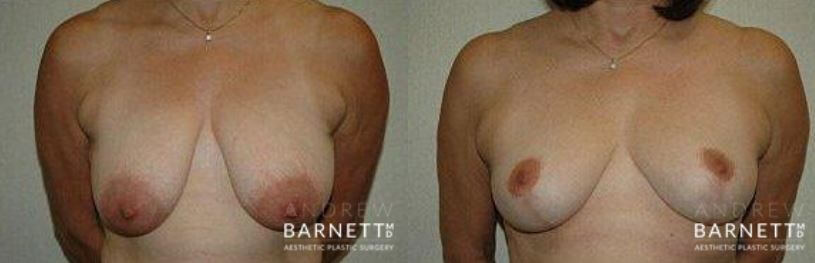 Breast Reduction Walnut Creek