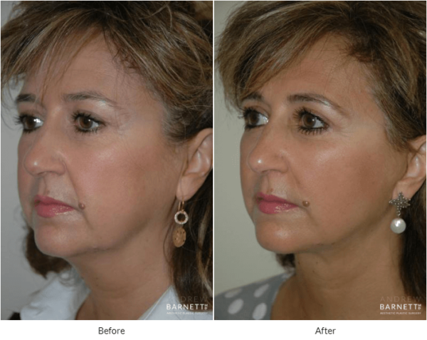 Facelift Walnut Creek