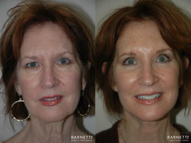 Facelift Walnut Creek