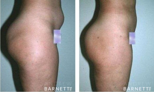 Liposuction Walnut Creek