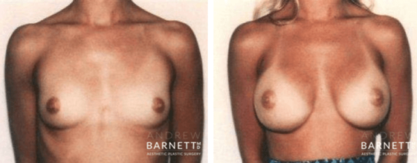Breast Augmentation Walnut Creek