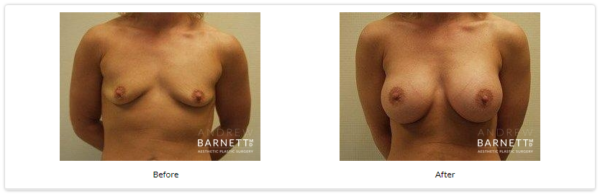 Breast Augmentation Walnut Creek