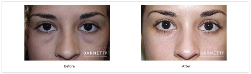 Eyelid Surgery Walnut Creek