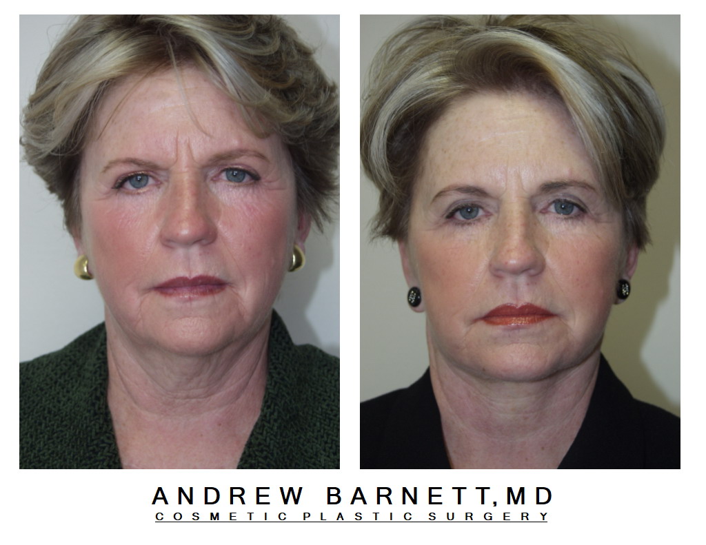 Patient001 — Frontal View