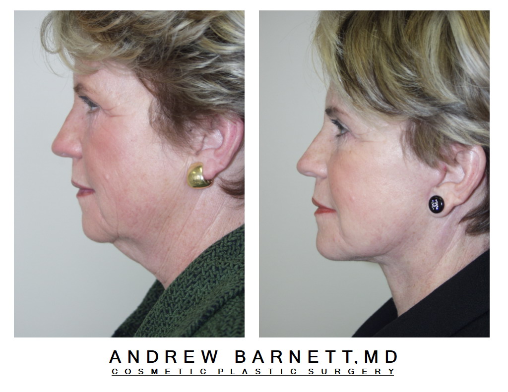 Patient001 — Profile View