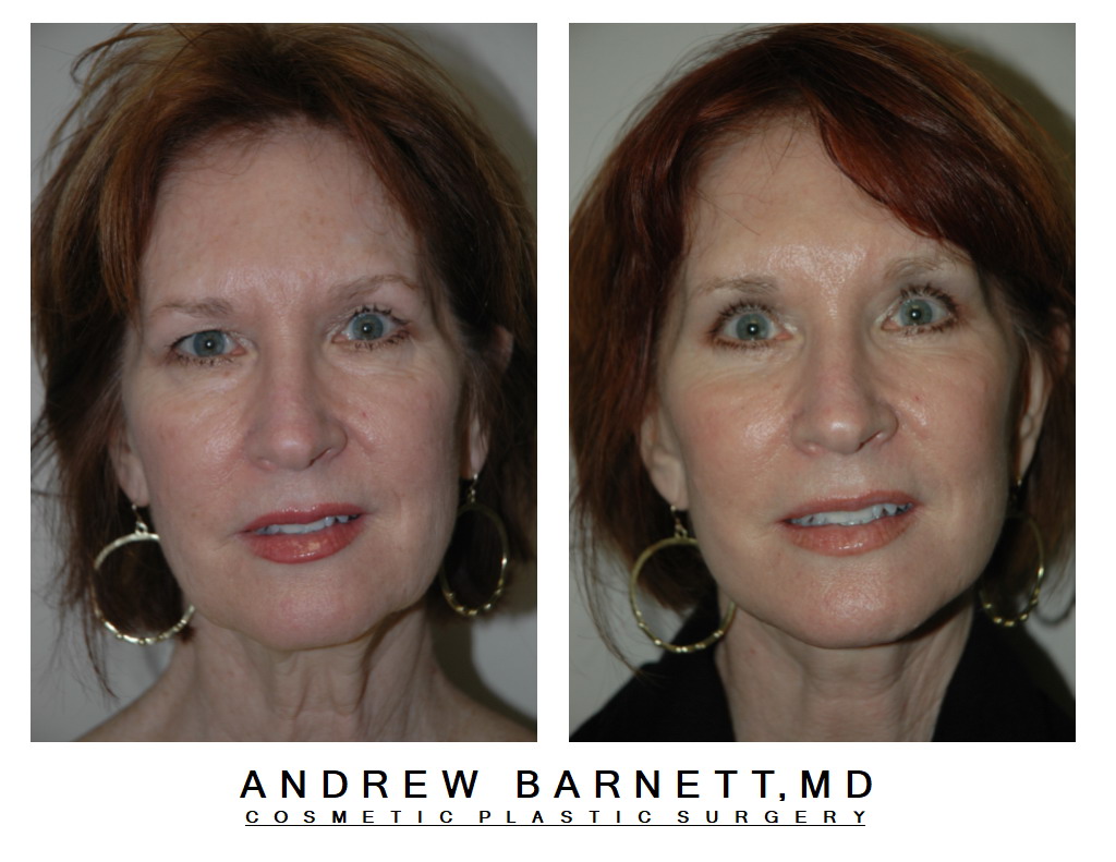 Patient002 — Frontal View